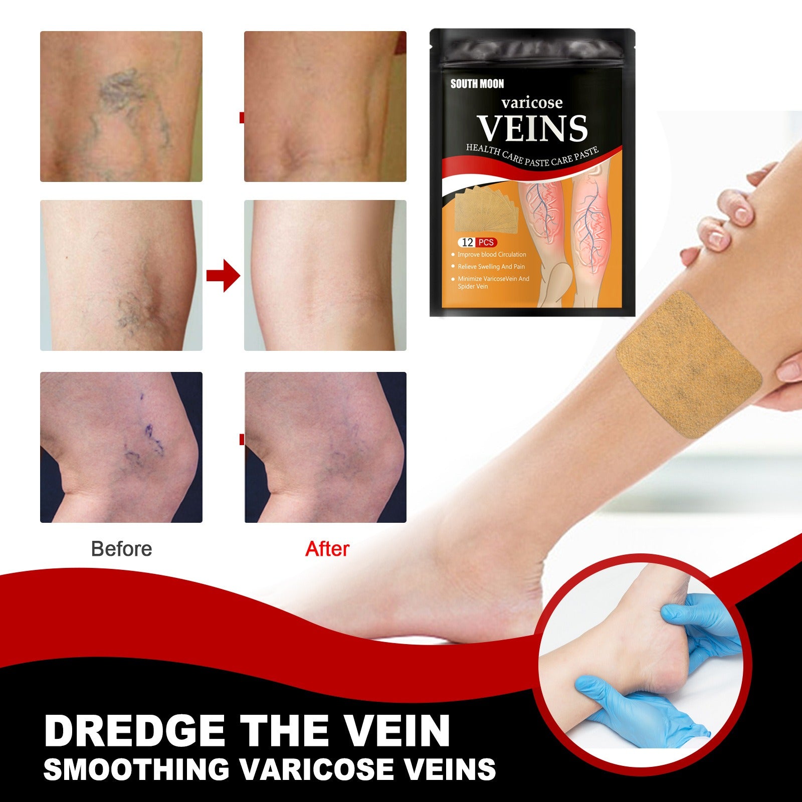 Venous health patch relieves varicose blood vessel blockage and protrusions in the feet. Cold compress venous health patch eprolo